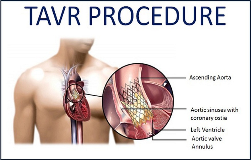 TAVI/TAVR treatment in Dubai